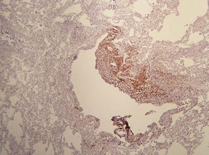 Surgical lung biopsy showing spindle cells in the wall of a cystic space stain for HMB-45; 400×.