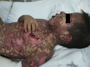 Case 1. The patient presented with widespread dermatosis manifested by papuloerythematous injuries and blisters that were mainly on the face, neck, trunk, limbs, and genitals; with necrotising lesions and loss of continuity characterised by patches; and with a positive Nikolsky sign and blisters that converged into bullae of serous content, involving only the palms and soles.