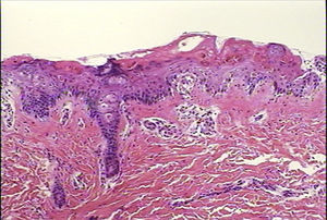 Case 1. Skin biopsy displaying the altered epidermis. Degenerative vacuolar changes are observed in the dermoepidermal junction, accompanied by alterations in the stratified maturation of the acanthocytes. The inflammatory exudate is extremely scarce and is limited to the papillary dermis. Haematoxylin and eosin (H–E) stain, 10×.
