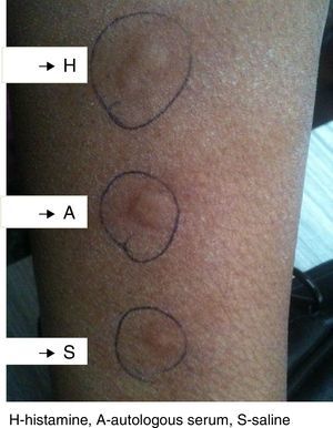 Shows wheal formation in ASST (autologous serum skin test) positive patient.