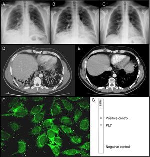 Chest radiography on the first visit (A); the second visit (B); and 30 days after starting treatment (C). CAT scan done during the second visit (D); and 8 months after treatment (E). Immunofluorescence on HEp-2 cells showing PL-7 autoantibodies (F). Dot-blot with recombinant antigens showing PL7 reactivity (G).