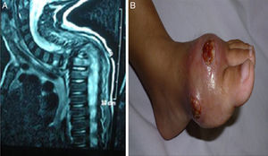 (patient no. 26b). (A) MRI cervical and spine with IV contrast showing marked kyphotic deformity, collapsed D2 and D3 vertebral bodies with consequent compression of the cord at that level (complication of HLH). (B) Osteomyelitis, ulceration with destruction of 1st metatarsal bone as complication of infection with atypical mycobacteria.