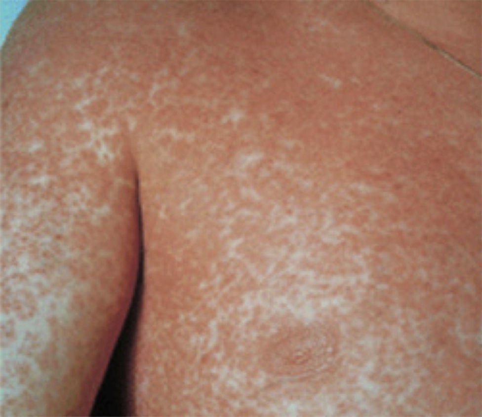 Morbilliform Ramaculopapular Rssh Severe delayed skin reactions related to drugs in the paediatric age ...