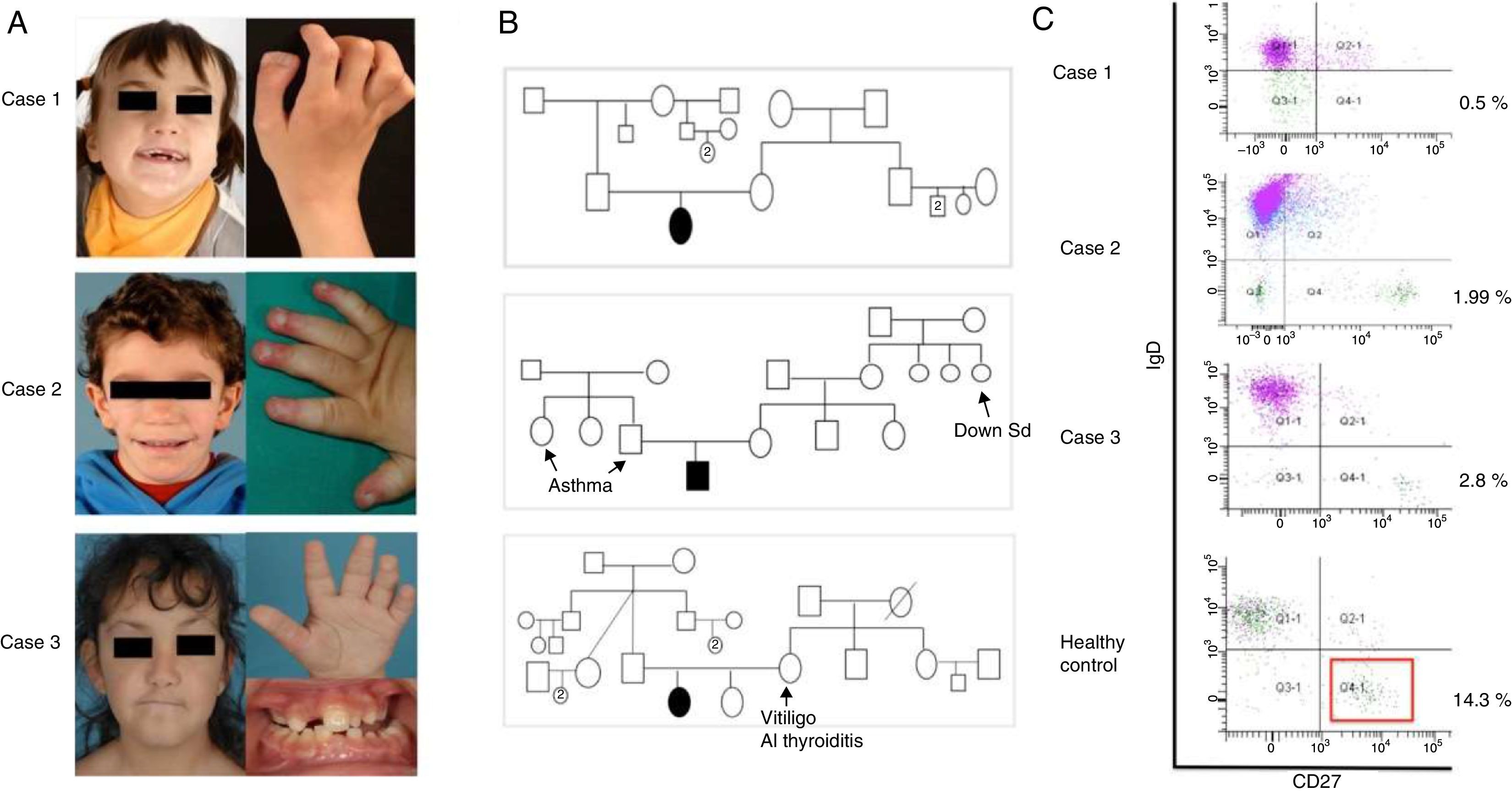Humoral deficiency in three paediatric patients with genetic diseases ...