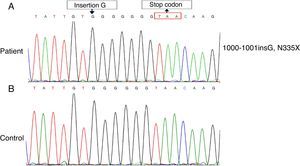 Diagrams of WASP mutation identified by sequencing method in patient. (A) Normal. (B) The mutation, 1000–1001 ins (G), which lead to a frameshift (p.G334GfsX1), resulting in a premature termination codon at amino acid 335 (N335X).