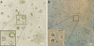 Morphological appearance of MCM-DCs (A) and Induced-DCs (B). Analysis by inverted microscope revealed that in comparison, Induced-DC were longer and had more frills than MCM-DC. These cells (both groups) looked larger than monocytes containing large intracellular granules also were more non-adherent.