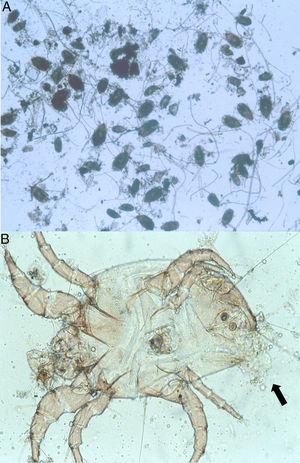 (A) Dermatophagoides sp. in a house dust sample (40×). (B) D. pteronyssinus, male adult, ventral side. Next to the anal aperture, the intestinal content is coming out when the mite has been squashed (indicated by the black arrow) (400×).