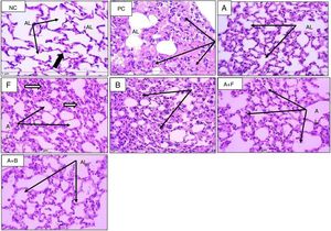 Sections from mice lung (H&E stain) (×400) showing alveoli of normal control (NC), positive control (PC), and inhaled albuterol (A), furosemide (F), bumetanide (B), albuterol+furosemide (A+F), and albuterol+bumetanide (A+B). Normal control (NC) shows patent lumina, thin wall (thin black arrows) and few inflammatory cells (black thick arrow). Positive control (PC) shows consolidated alveoli and thickened walls (arrows). Lumina are filled with pinkish stained mucous and inflammatory cells. Albuterol (A) shows normal patent alveoli (arrows) with thin wall lining epithelium. Furosemide (F) shows patent alveoli with slight thickening of alveolar wall and some contains inflammatory cells (arrows). Bumetanide (B) shows that most alveoli are consolidated with inflammatory cell infiltrate (arrows) and few alveoli are patent. Albuterol+furosemide (A+F) shows healthy patent alveoli (AL) within thin epithelial lining (arrows). Albuterol+bumetanide (A+B) shows that most alveoli (AL) are patents (arrows) and few contain inflammatory cells.