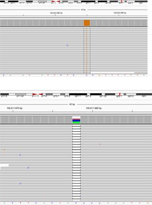 Sequence view of novel mutations in BTK gene of the cases. Parents scanned for the same mutation in order to confirm the data collected, and heterozygous mutations were detected in the same position and defined as a carrier. Patient Number 3-I and 3-II: (a) NGS data electropherogram tracing of the exon 5 in BTK gene showing the novel homozygous mutation c. Patient Number 9: (b) NGS data electropherogram tracing of the exon 14 in BTK gene showing the novel homozygous mutation c.