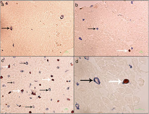 IHC slides of esophagus biopsy (×400) of: (a) a normal person, (b) a patient with GERD, (c) a patient with EoE, (d) a double-positive cell (Treg) ×1000. Black arrow shows T lymphocytes and white arrow shows regulatory T cells.