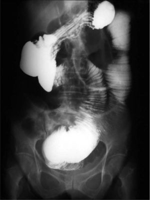 Dilatación de asas intestinales.