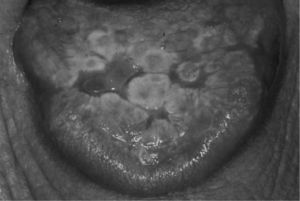 Lesiones linguales papulares y en placa, junto a una área ulcerada y zonas atróficas eritematosas.