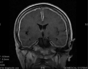 Resonancia magnética de cráneo: engrasamiento meníngeo difuso, que realza de forma importante con la administración de gadolinio.