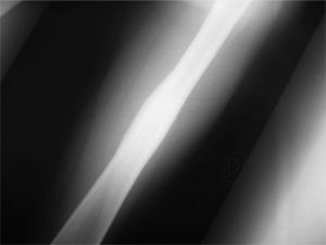 Radiografía de fémur donde se podía apreciar reacción perióstica con zona osteoblástica fusiforme, típica del osteoma osteoide diafisario en pacientes esqueléticamente inmaduros.