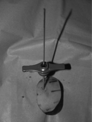 Fotografía del paciente del caso 2; se observa que la posición del orificio en el hueso se mantiene con una trefina de biopsia a través de la cual se introduce la sonda de radiofrecuencia.