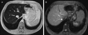 Resonancia magnética hepática de paciente con hemocromatosis hereditaria tipo 1 en el momento del diagnóstico (A: 195μmol Fe/g) y a los 3 años, tras flebotomías (B: cuantificación de hierro en hígado, normal).