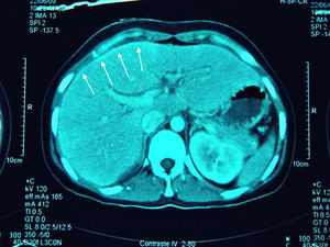 TC abdominal. Realce con el contraste intravenoso de la cápsula hepática (flechas).