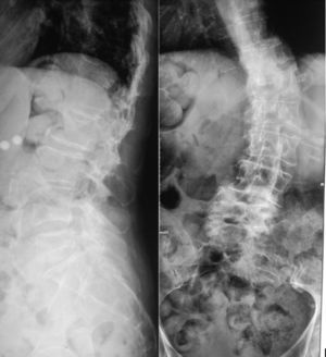 Radiografía simple de columna anteroposterior y lateral.