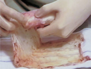 Recubrimiento del molde vaginal con la membrana.