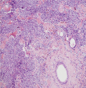 Linfoma B de grado bajo (linfoma de la zona marginal). Se observa un conducto mamario atrapado por una proliferación neoplásica linfocitaria. Tinción HE 20×.