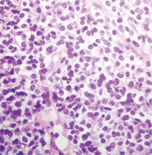 Linfoma B de grado bajo (linfoma de la zona marginal). Los linfocitos son de tamaño mediano, de contornos redondeados a irregulares, e invaden el epitelio glandular en pequeños nidos. Tinción HE 40×.