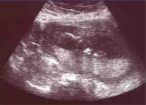 Embrión con biometría de 12–13 semanas con ausencia de frecuencia cardíaca.