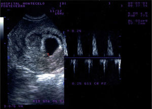 Latido embriocárdico postextracción del DIU.