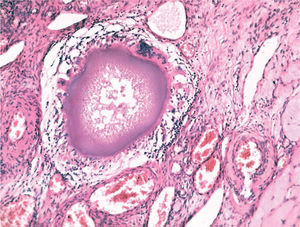Caso 1. Partículas de localización intravascular.