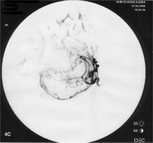 Caso 2. Imagen vascular: mioma de 88 × 85× 53mm.