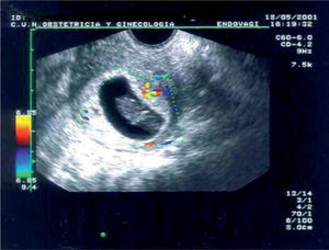 Aborto diferido. Se observa al embrión sin actividad cardíaca a la exploración con Doppler color.