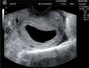 Gestación anembrionada. Se observa un saco gestacional grande, sin vesícula ni embrión.