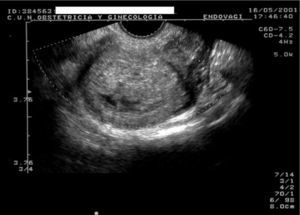 Aborto incompleto. Se observa una cavidad uterina con contenido heterogéneo.