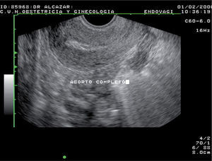 Aborto completo. Endometrio fino homogéneo compatible con útero vacío.