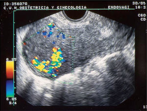 Aborto incompleto. La exploración con Doppler color revela la presencia de un área vascular importante localizada, compatible con restos retenidos.