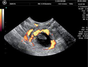 Embarazo ectópico. Puede observarse el saco con el embrión y el anillo vascular trofoblástico.