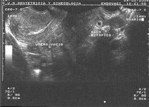 Embarazo ectópico. Puede observarse el saco gestacional en la trompa (anillo tubárico) y el útero vacío.