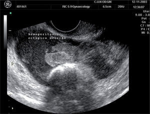 Embarazo ectópico. Puede observarse una masa anexial con líquido alrededor compatible con hemoperitoneo.