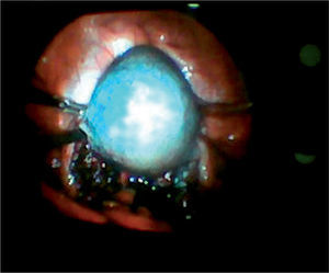 Imagen laparoscópica. Endometriosis pélvica extensa (Tipo IV) y endometrioma de ovario izquierdo.