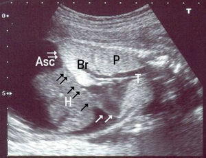 En un corte longitudinal del feto podemos localizar el recorrido de la tráquea (T) y los bronquios (Br), ambos dilatados. Podemos ver igualmente la abundante ascitis (Asc) en la zona abdomianl que rodea al hígado (H). Los pulmones (P) se visualizan hiperecogénicos y alargados, favoreciendo la inversión diafragmática (flechas).