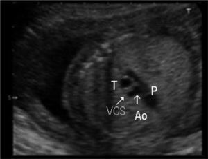 En el corte 3VT de Yagel destaca la visualización de la tráquea (T) dilatada, de manera que presenta un diámetro mayor que los vasos visibles en dicho corte: pulmonar (P), aorta (Ao) y vena cava superior (VCS).