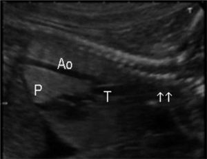 En un corte longitudinal podemos seguir el trayecto dilatado de la tráquea (T) y apreciar el proceso obstructivo (flechas) en la zona alta de la vía aérea (tráquea, glotis). Ao: aorta; P: pulmones.
