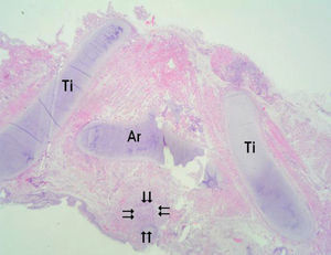 Estudio anatomopatológico donde se puede apreciar la vía aérea estenosada (rodeada por flechas), el cartílago tiroides (Ti) y el cartílago aritenoides (Ar).