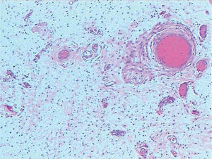 Células fusiformes inmersas en una estroma mixoide con prominentes estructuras vasculares, algunas de ellas de pared gruesa (HE, ×10).