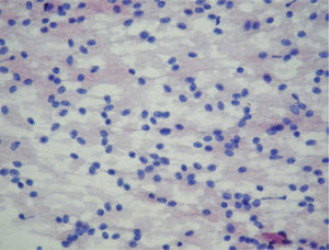 Extensiones con abundante celularidad dehiscente en la que predominan los núcleos desnudos de cromatina grumosa, en «sal y pimiento», sin necrosis ni mitosis.