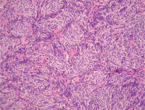 Tumor con crecimiento organoide constituido por células monótonas con atipia escasa y sin actividad mitótica aparente, muchas de ellas fusiformes.