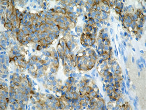 Las células muestran inmunorreactividad citoplásmica para marcadores neuroendocrinos (cromograma).