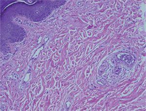 Biopsia cutánea que muestra en la dermis superior un trombo hialino vascular y un pequeño trombo recanalizado (HE, ×10).