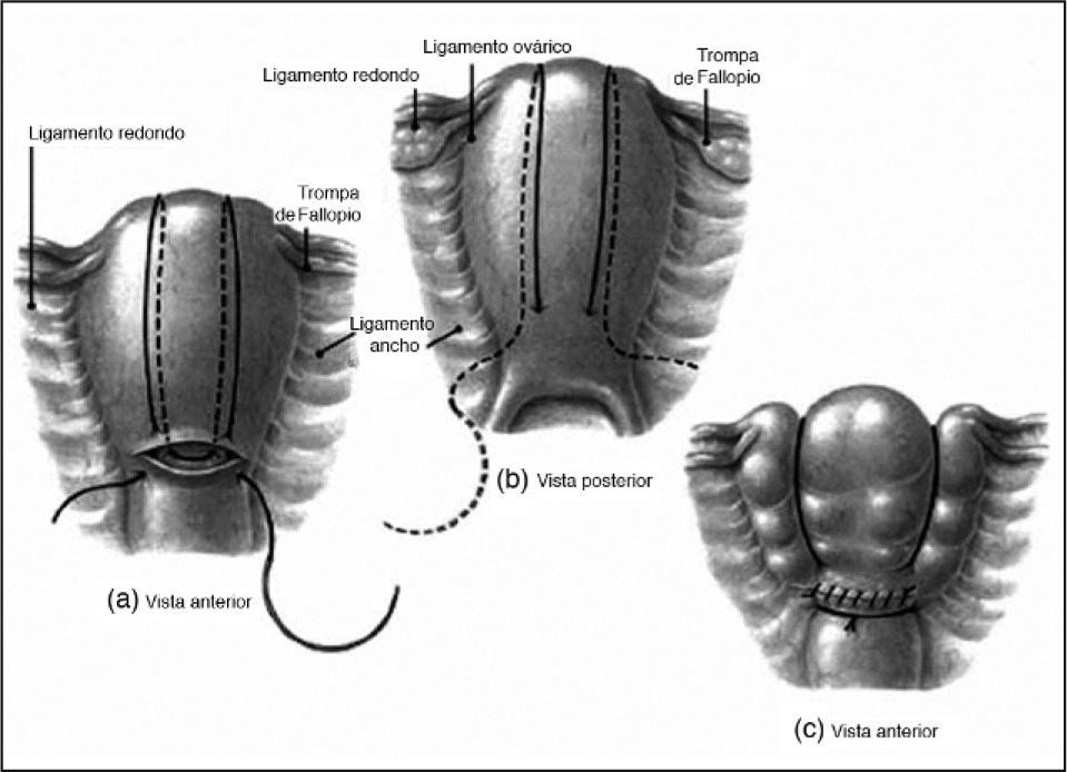 Técnica de B-Lynch en el control de la hemorragia posparto | Progresos ...