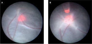Imagen endoscópica de vasos placentarios anastomóticos antes (A) y después (B) de la coagulación con láser.