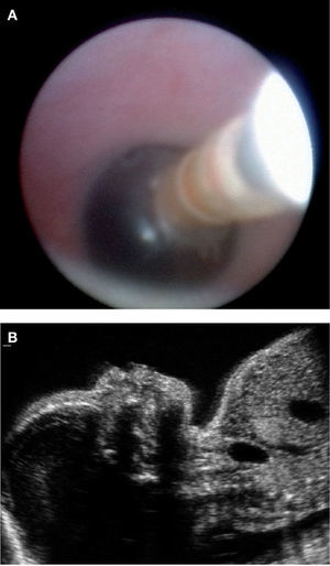 Colocación de un balón intratraqueal en un feto de 28 semanas. Imagen endoscópica (A) y ecográfica (B) del balón inflado en la tráquea.